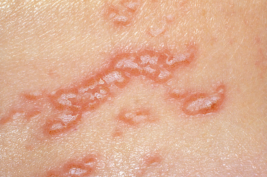 herpes genital