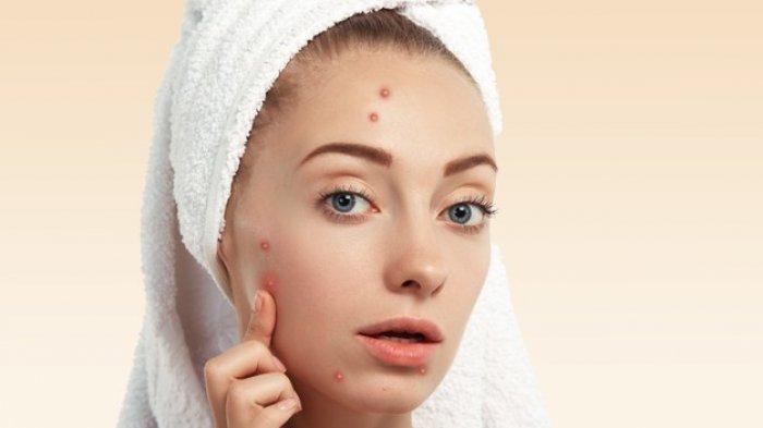 cara mengatasi jerawat