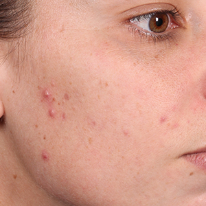 jerawat di pipi